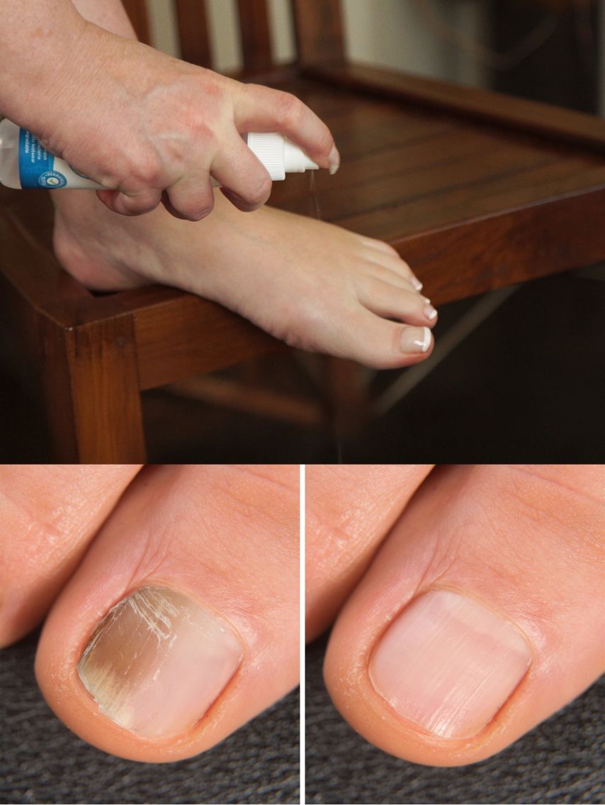 Produktbild von Anti-Fuß-/Nagelpilzspray, 2er Set