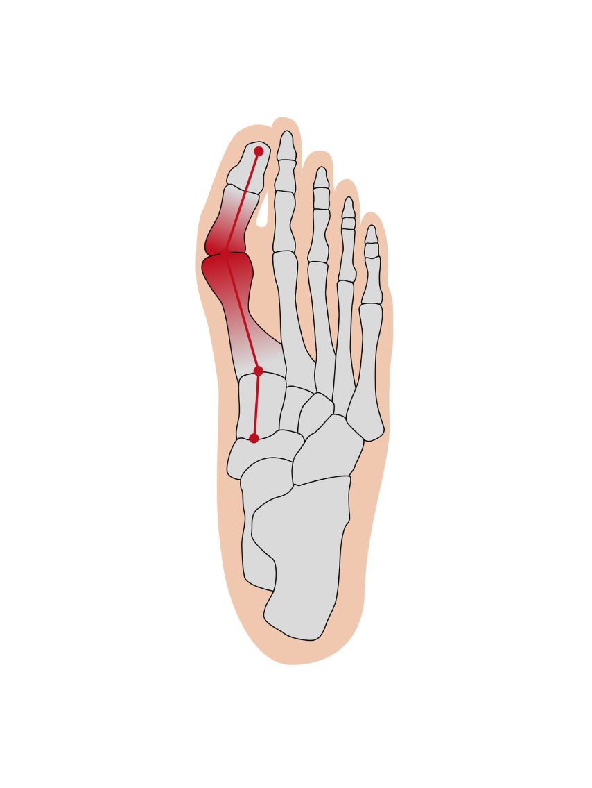 Produktbild von Hallux Soft Bandage rechts