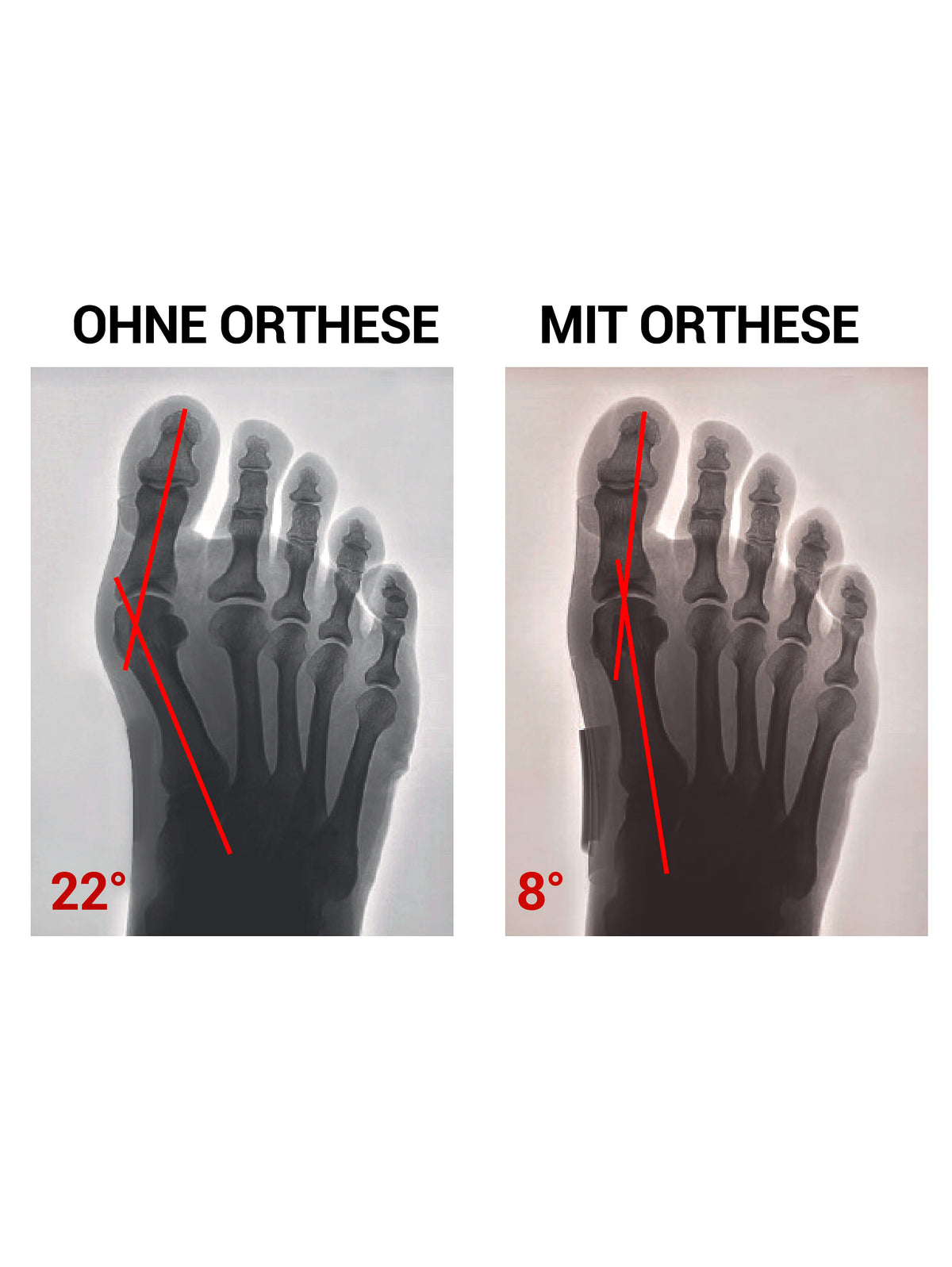 Produktbild von Hallux Valgus