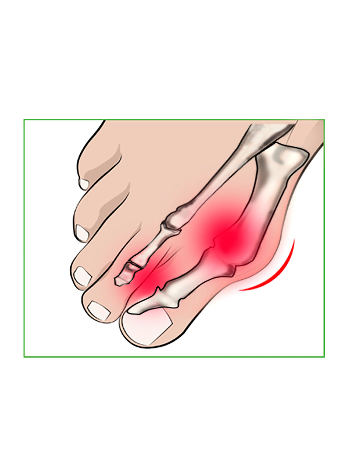 Produktbild von Hallux Valgus und Mittelfuß Kissen